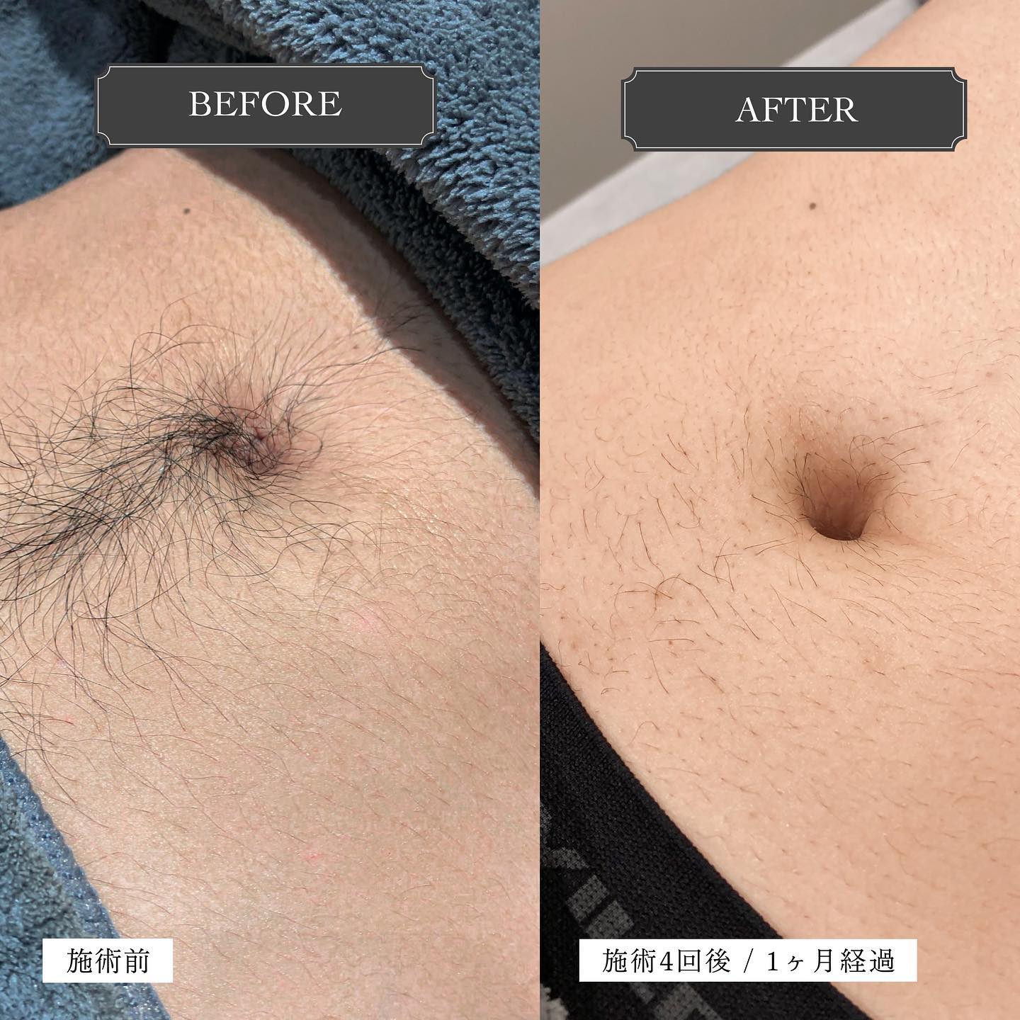 .【Before︎After】.当サロンで施術させていただいているお客様のお腹のお写真🪄..右は施術4回後、1ヶ月後まで自己処理無しでお写真を撮らせていただきました.どんどん毛量が減り、毛が細くなってきているとのこと.普段見えない場所の毛がコンプレックスの方も多いですよね🥺お腹や胸の毛を自己処理している方、結構おられるのではないでしょうか？.カミソリで剃るとすぐ伸びてきてチクチクしてしまいますし、皮膚を傷つけてしまうことも多々あると思います‍♀️..サロンで脱毛することで自分の肌に自信が持てますよ️.ご希望の方には無料でパッチテストも行なっておりますのでお痛みの程度が気になる方もご安心くださいね️..お客様のお悩みやご予算に応じてスタッフがあなただけの脱毛プランをご提案します♪🧑🏻‍無料カウンセリングのご予約はホームページ、又はホットペッパーよりお気軽にどうぞ🪄@glanz_2021 ..———————————————————2021年3月31日グランドオープン！🦌———————————————————.️GLANZ -グランズ-️https://glanzashiya.com/.≪無料カウンセリングのご予約受付中≫／／ HPからご予約いただけます！＼＼.[ADDRESS]〒659-0065 兵庫県芦屋市公光町7-12メインステージ芦屋公光3階.︎阪神本線　阪神芦屋駅徒歩1分︎近隣にコインパーキング多数有り︎芦屋警察署の裏.[TEL]080-6521-5785.[MAIL]glanz.ashiya@icloud.com.[営業時間]11:00〜21:00(最終受付20:00).[定休日]不定休.———————————————————..#ひげ脱毛 #メンズ脱毛 #髭脱毛 #ヒゲ脱毛 #男性脱毛 #男性美容 #芦屋脱毛サロン #光脱毛 #芦屋 #メンズ脱毛サロン #芦屋エステ #全身脱毛 #神戸脱毛 #神戸メンズ脱毛 #メンズ脱毛サロン #西宮メンズ脱毛 #vio脱毛 #美容 #芦屋市 #阪神芦屋 #タイガース #阪神 #阪神タイガース #オリックス #美容男子 #おしゃれ男子 #痛くない脱毛 #芦屋脱毛 #脱毛キャンペーン #西宮脱毛 #学生脱毛 .