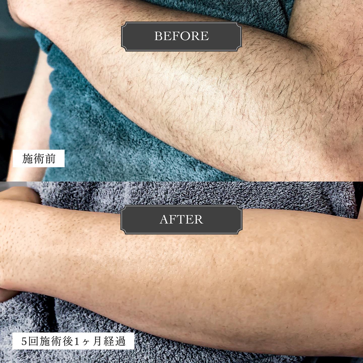 .【Before︎After】.こちらは、お久しぶりの️スタッフのビフォーアフターお写真です🏻..上のお写真は施術前の腕、下は施術5回後、1ヶ月経過しています💭(照射後、自己処理なし‍♂️)..まだまばらに毛は残っていますが、毛量が減り毛が細くなっているので毛穴も目立たなくなっていますよね🪄..普通に自己処理しただけだと、すぐ毛が生えてきてしまいますよね…！.脱毛の回数を重ねると、自己処理せずともツルツルをキープできるようになります🏻..回数にお悩みの方や、効果に不安のある方もカウンセリング時にご相談くださいねお客様にぴったりのコースをご提案させていただきます🧑🏻‍..カウンセリングはHotpepperまたはホームページからお願いします🦌@glanz_2021 ..️GLANZ -グランズ-️https://glanzashiya.com/.[ADDRESS]〒659-0065 兵庫県芦屋市公光町7-12メインステージ芦屋公光3階.︎阪神本線　阪神芦屋駅徒歩1分︎近隣にコインパーキング多数有り︎芦屋警察署の裏.[TEL]080-6521-5785.[MAIL]glanz.ashiya@icloud.com.[営業時間]11:00〜21:00(最終受付20:00).[定休日]不定休.———————————————————...#ひげ脱毛 #メンズ脱毛 #髭脱毛 #ヒゲ脱毛 #男性脱毛 #男性美容 #芦屋脱毛サロン #光脱毛 #ワックス脱毛 #wax脱毛 #芦屋 #メンズ脱毛サロン #芦屋エステ #全身脱毛 #神戸脱毛 #神戸メンズ脱毛 #メンズ脱毛サロン #西宮メンズ脱毛 #vio脱毛 #美容 #芦屋市 #阪神芦屋 #タイガース #阪神 #阪神タイガース  #美容男子 #痛くない脱毛 #芦屋脱毛 #脱毛キャンペーン #西宮脱毛 #脱毛キャンペーン .