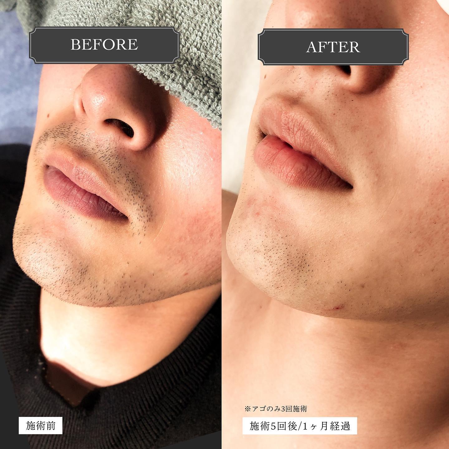 .【Before︎After】.こちらは顔セット脱毛ビフォーアフターの写真です🏻.左は施術前の顔の写真、右は施術5回後、1ヶ月経過していますアゴは将来生やしたくなるかも？とのことで3回でひとまず施術をストップしてます..鼻下、アゴ下の変化にご注目明らかに毛量が減っているのがお分かりいただけると思います️..5回となりますと、勿論個人差はございますが日々の髭剃りが少し楽になった！というお客様の喜びの声も耳にします.ツルツルを目指すならまだ回数は必要となりますが、"毛量を減らしたい""髭剃りの負担を少し減らしたい"そういう方は、5回コースで様子見もアリかもしれません◎🏻‍.どうせならツルツルを目指したい！という方には、割引率が最も高い10回コースがオススメにはなります..好みの量まで減らすことを目標にしておられる方や、形をキープする為にデザイン脱毛をされる方など、目的は様々🧏🏻‍♂️.一言でヒゲ脱毛と言っても最終目標は人それぞれなんです🪄..このあたりはカウンセリングでお客様とじっくりご相談して、ベストな脱毛プランを見つけられたらと思います♪🏻..Hotpepperには初回クーポンをご用意しておりますので、お試しも大歓迎ですよ🧑🏻‍.顔セット(全体)脱毛は初回半額以下️《1回　8,400円 ⇢ 3,000円》※鼻下、アゴ、アゴ下、首、もみあげ、ほほ、おでこ..是非ご予約お待ちしております♪@glanz_2021 ..️GLANZ -グランズ-️https://glanzashiya.com/.≪無料カウンセリングのご予約受付中≫／／ HotpepperまたHPから！ ＼＼.[ADDRESS]〒659-0065 兵庫県芦屋市公光町7-12メインステージ芦屋公光3階.︎阪神本線　阪神芦屋駅徒歩1分︎近隣にコインパーキング多数有り︎芦屋警察署の裏.[TEL]080-6521-5785.[MAIL]glanz.ashiya@icloud.com.[営業時間]11:00〜21:00(最終受付20:00).[定休日]不定休.———————————————————...#ひげ脱毛 #メンズ脱毛 #髭脱毛 #ヒゲ脱毛 #男性脱毛 #男性美容 #芦屋脱毛サロン #光脱毛 #ワックス脱毛 #wax脱毛 #芦屋 #メンズ脱毛サロン #芦屋エステ #全身脱毛 #神戸脱毛 #神戸メンズ脱毛 #メンズ脱毛サロン #西宮メンズ脱毛 #vio脱毛 #美容 #芦屋市 #阪神芦屋 #タイガース #阪神 #阪神タイガース  #美容男子 #痛くない脱毛 #芦屋脱毛 #脱毛キャンペーン #西宮脱毛 #脱毛キャンペーン #hotpepperbeauty .