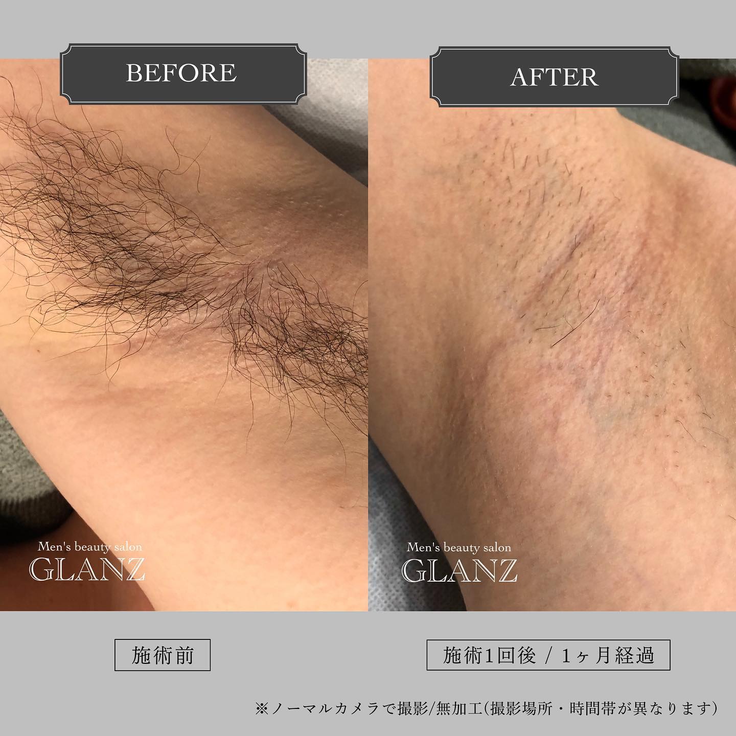 .【Before ⇢ After】.こちらはお客様の、ワキのビフォーアフターのお写真になります.今まで一度も剃ったことがなかった、というお客様🪒🏻.「脱毛するまでは、毛がないのは気持ち悪いかも？と思っていたけど今は毛があることが気持ち悪く見える」とおっしゃっていました.その通りで、皆様一度剃るとその快適さに気づかれます︎.ワキも特にスッキリ感を感じられる箇所..自分で剃っただけでは、一日経つとすぐに毛が伸びてチクチクしてきてしまいますよね.このお写真は、一度打ってから1ヶ月一度も剃らずに来ていただいたお写真になります🧑🏻‍(ノーマルカメラ、まったくの無加工です♪)..回数を重ねることで自己処理が必要なくなるツルツル美肌を目指せます..あなたもこの快適さを知ればきっとクセになりますよ️🤲🏻.脱毛は、友人や奥様から勧められて始める方も多いです♬脱毛の良さを知ると、きっと周りにも勧めたくなるはず🎖‍♂️..お試しも大歓迎ですので是非ご相談だけでもお気軽にどうぞ🪄@glanz_2021 .︎今月限定で、Hotpepperにヒゲ脱毛(顔全体)8,400円が980円で受けられるクーポンもあります❣️.お得なチャンスをお見逃しなく🏻..️GLANZ -グランズ-️https://glanzashiya.com/.≪無料カウンセリングのご予約受付中≫／／ HotpepperまたHPから！ ＼＼.[ADDRESS]〒659-0065 兵庫県芦屋市公光町7-12メインステージ芦屋公光3階.︎阪神本線　阪神芦屋駅徒歩1分︎近隣にコインパーキング多数有り︎芦屋警察署の裏.[TEL]080-6521-5785.[MAIL]glanz.ashiya@icloud.com.[営業時間]11:00〜21:00(最終受付20:00).[定休日]不定休.———————————————————...#ひげ脱毛 #メンズ脱毛 #髭脱毛 #ヒゲ脱毛 #男性脱毛 #男性美容 #芦屋脱毛サロン #光脱毛 #ワックス脱毛 #芦屋 #メンズ脱毛サロン #芦屋エステ #全身脱毛 #神戸脱毛 #神戸メンズ脱毛 #メンズ脱毛サロン #西宮メンズ脱毛 #vio脱毛 #美容 #芦屋市 #タイガース #阪神 #美容男子 #痛くない脱毛 #芦屋脱毛 #脱毛キャンペーン #西宮脱毛 #hotpepperbeauty #脱毛 #脱毛器 #脱毛サロン.